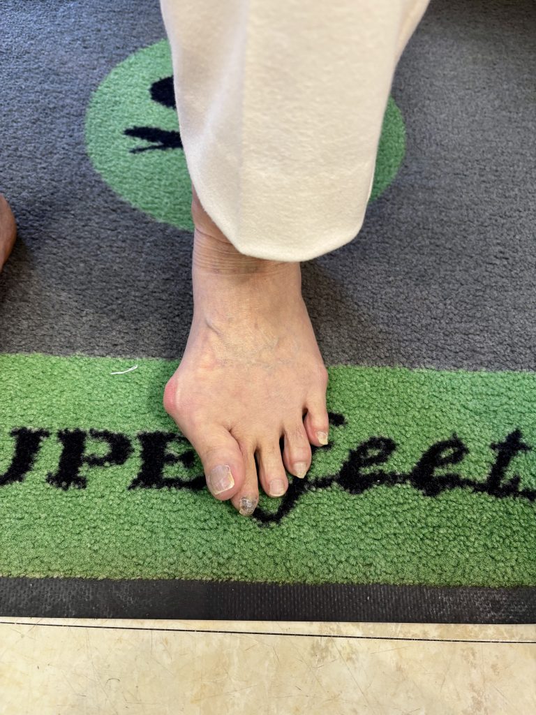 【保存版】外反母趾を悪化させない靴の選び方｜踵設計がすべて【テニスショップ通販店長のブログ＠テニスショップLAFINO 西山克久】