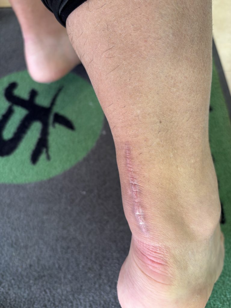 「アキレス腱は、シューズ選びで切れる」【テニスショップ通販店長のブログ＠テニスショップLAFINO 西山克久】