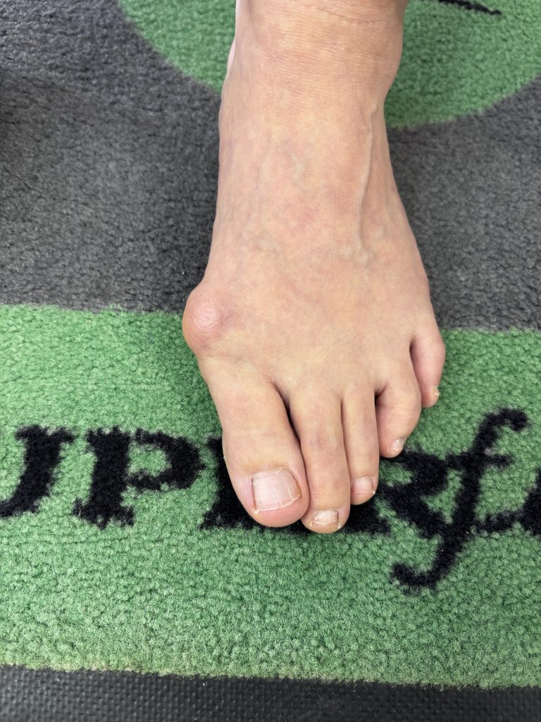 【保存版】外反母趾を悪化させない靴の選び方｜踵設計がすべて【テニスショップ通販店長のブログ＠テニスショップLAFINO 西山克久】