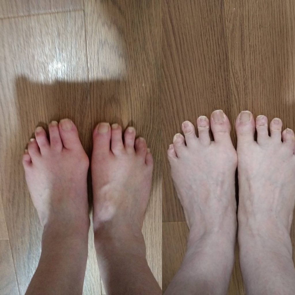 「外反母趾がここまで変わるなんて…！お客様から届いた衝撃の写真📸」【テニスショップ通販店長のブログ＠テニスショップLAFINO 西山克久】
