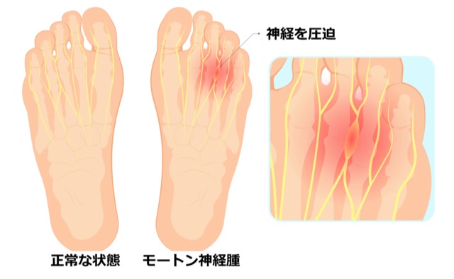 アパレル販売のお仕事をもっと楽にする魔法のインソールLIFE OTC。【テニスショップ通販店長のブログ＠テニスショップLAFINO 西山克久】