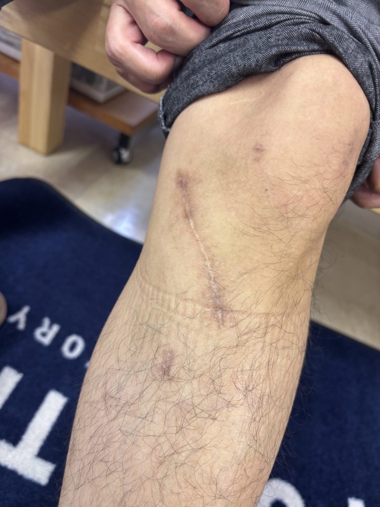 リハビリで足が変形？アメリカ足病医学が重視する”足元の安定”【テニスショップ通販店長のブログ＠テニスショップLAFINO 西山克久】