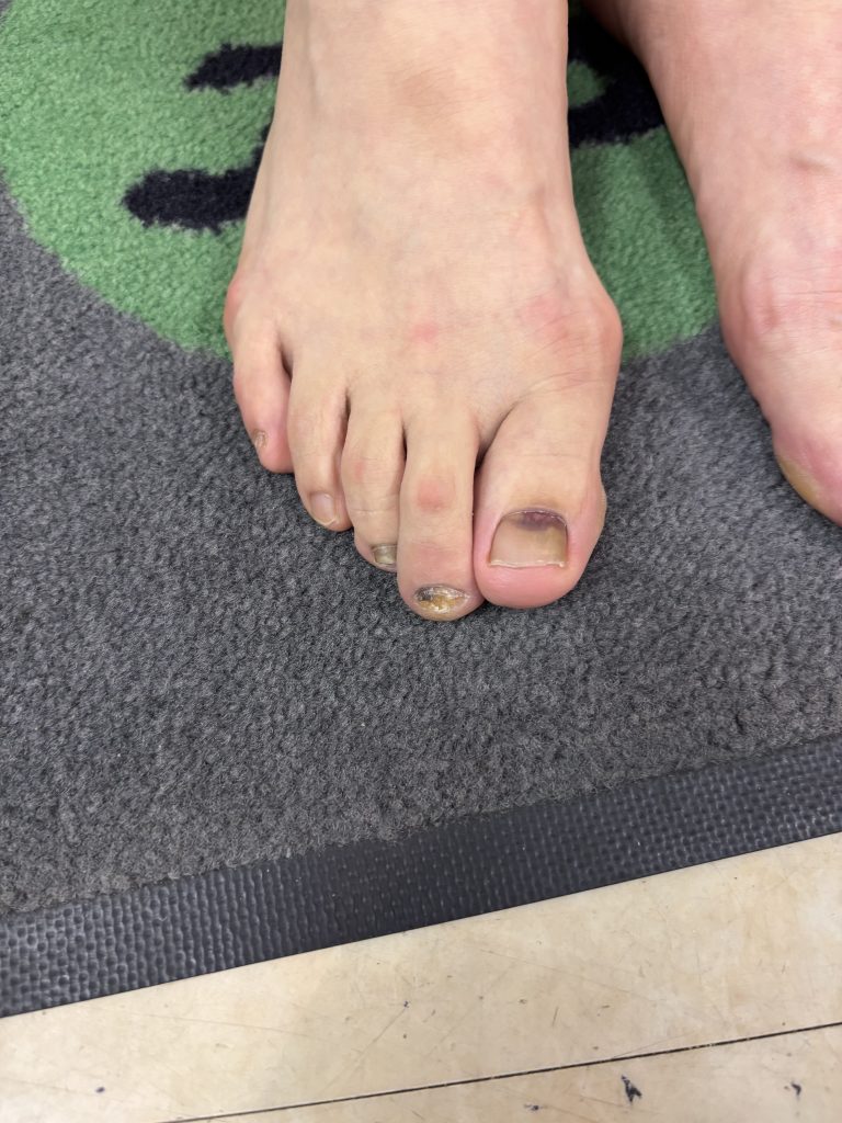 痛みの原因は“幅広シューズ”？  〜テニスを長く楽しむための足との付き合い方〜【テニスショップ通販店長のブログ＠テニスショップLAFINO 西山克久】