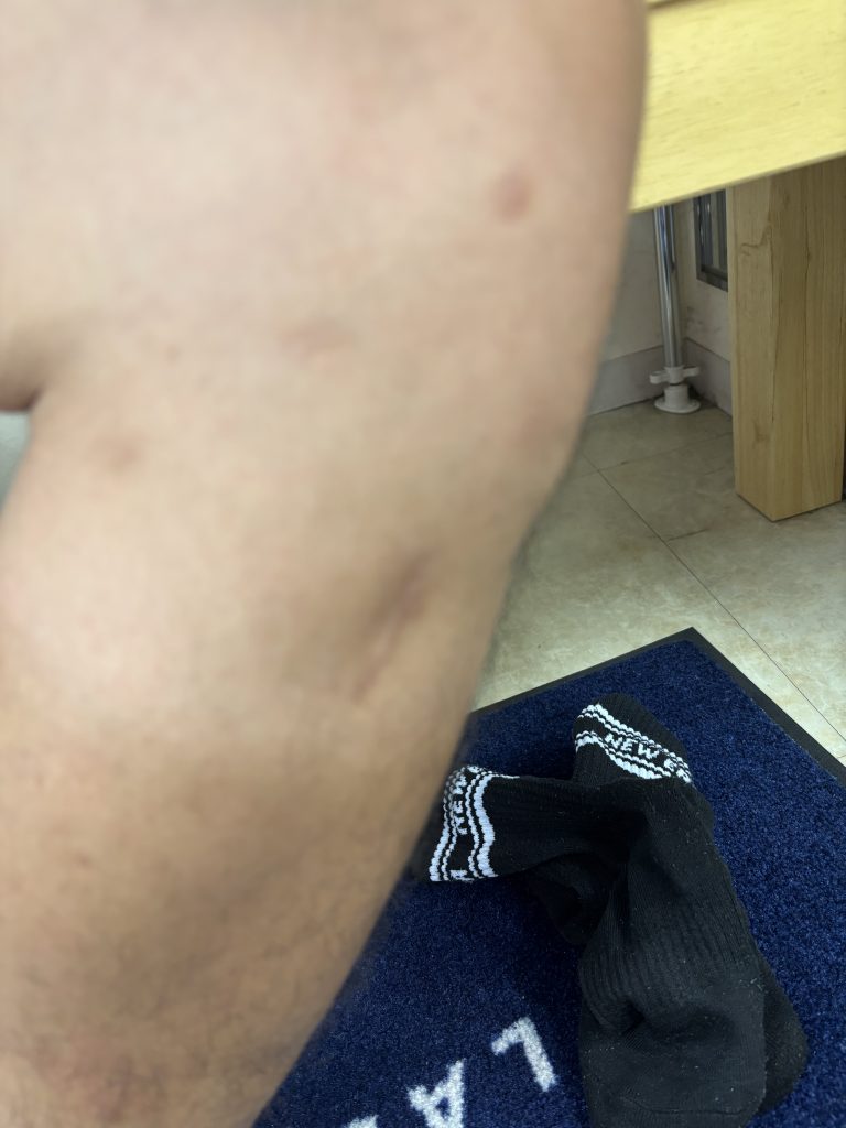 「膝の靭帯損傷、その原因を足元から考える」シューズとインソール【テニスショップ通販店長のブログ＠テニスショップLAFINO 西山克久】